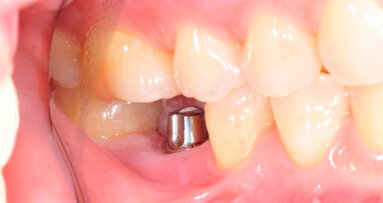 Oltre il 60 per cento dei dentisti esegue procedure di impianto dentale