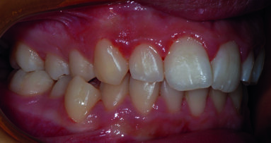 Cross-bite monolaterale e mandibular-shift. Trattamento con espansore palatino al nickel-titanio
