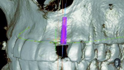 Lateral maxillary incisor implant – Key issues for aesthetic success