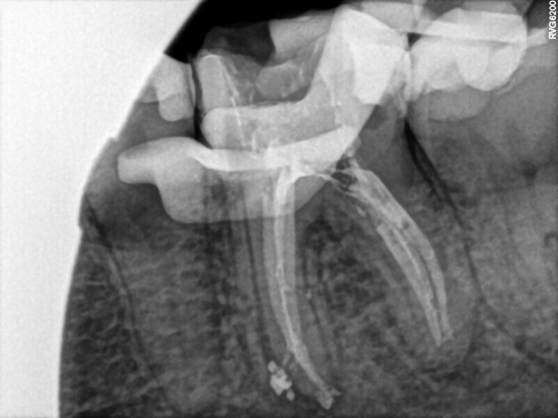 Fig. 34: Post-op radiograph.
