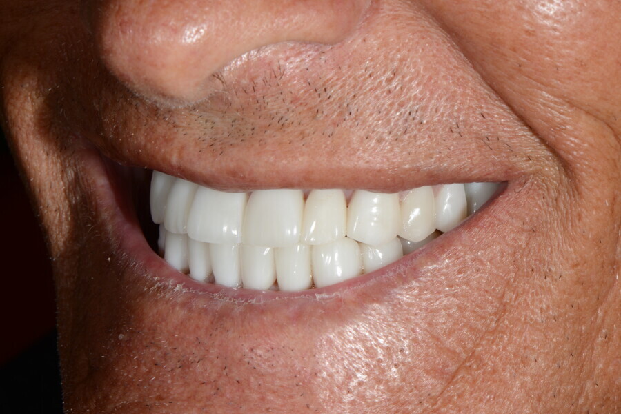 Fig. 32d: Left view of the patient’s final smile.