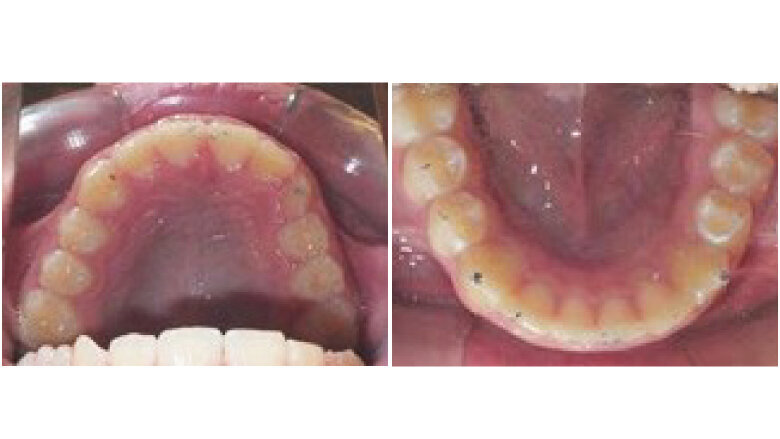 End of mandibular advancement phase after 11 months (initial aligners: U:27, L:27)