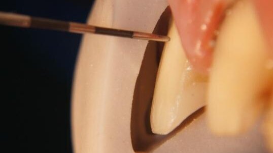 Ceramic and composite resin integration for custom smile design