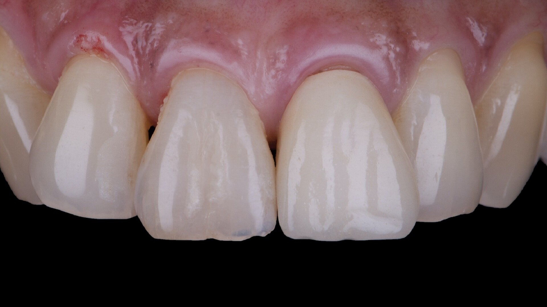 Immediate implant placement in the aesthetic zone: Two-year follow-up