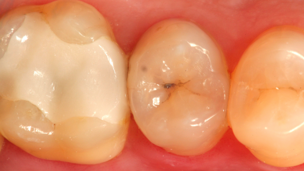 Una nueva técnica para eliminar la caries