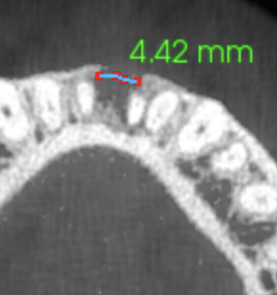 Fig. 6a: Horizontal view of the i-CAT scan taken at the nine-month follow-up showing a bone defect of only 4.42 mm. 