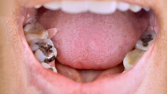 WHO advances action on dental amalgam phase‑out across Southeast Asia