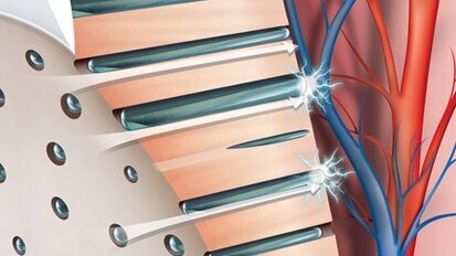Ipersensibilità dentinale semplificata