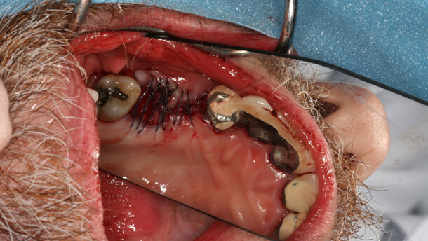 Patient’s own stem cells are harvested and transplanted into jaw