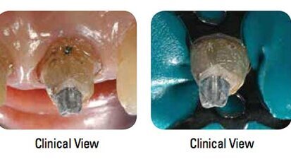 Enhanced clinical guide helps dentists save natural teeth Enhanced clinical guide helps dentists save natural teeth