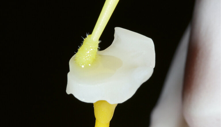 Fig. 8: Scrubbing Adhese Universal into the bonding surface for 20 s followed by drying with air