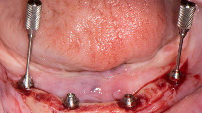 Straumann Pro Arch concept with fully guided implant and abutment placement Straumann Pro Arch concept with fully guided implant and abutment placement