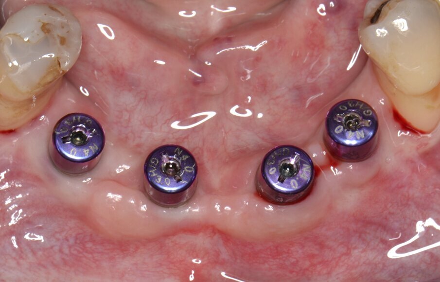 Fig. 14 - Gestione dei tessuti molli peri-implantari e condizionamento dei tragitti transmucosi.