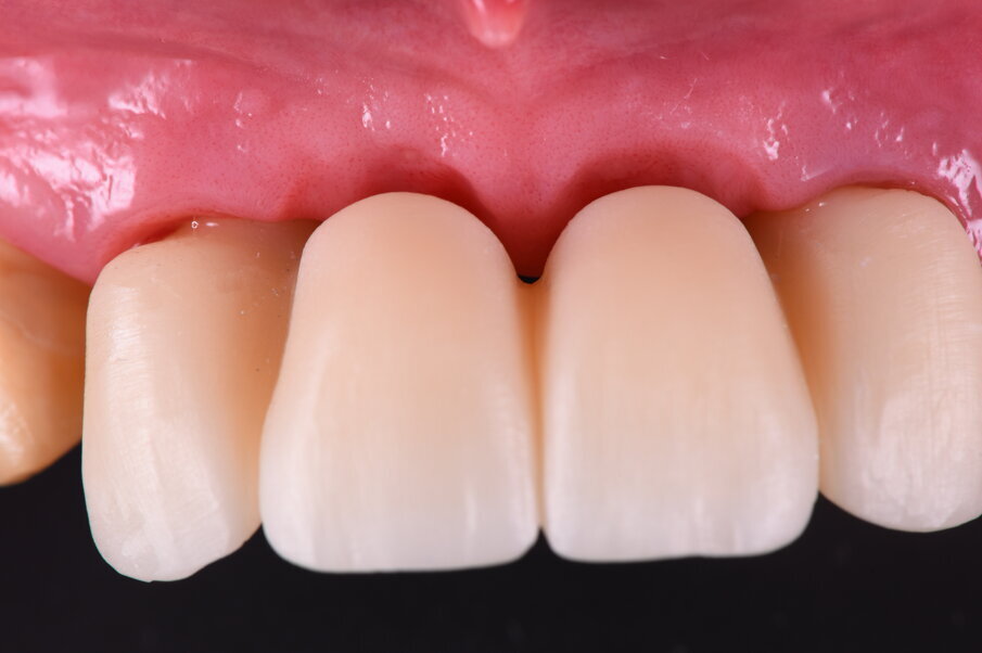 Fig. 41_Al momento della prova ci sono aspetti tecnici e biologici da valutare, infatti è importante capire se il tessuto si ischemizza, segno di una sofferenza. Data dalla compressione che è da evitare inoltre se sono state create ovettature gengivali capire se sono rispettati gli spazi per il passaggio di scovolini e ausili per il mantenimento e la detersione.
