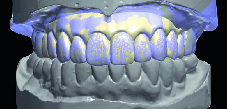 Fig 10. Two sets of STL data were super-imposed and sent for milling.