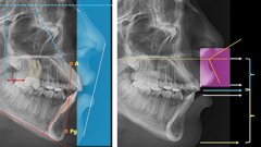 Acotaciones al uso de la cefalometría