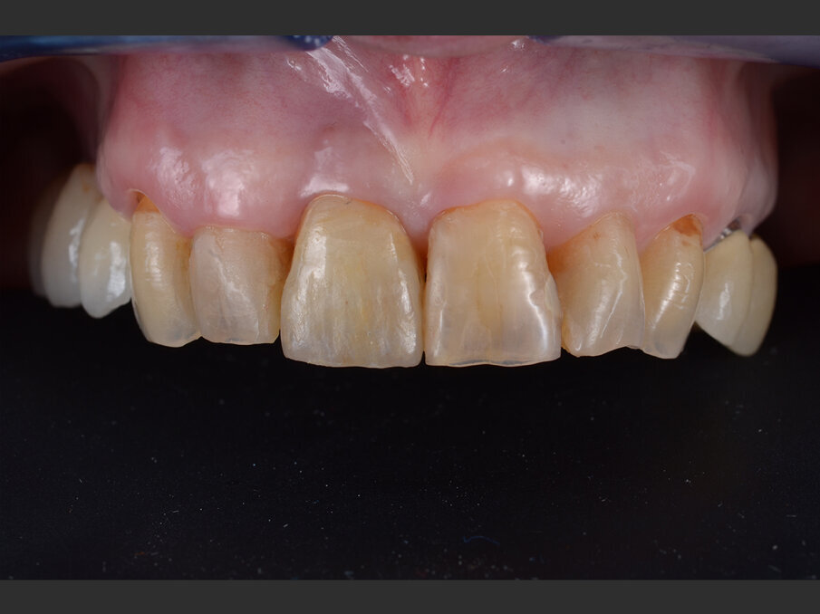 Fig. 11 - Valutazione post-operatoria: riabilitazione definitiva in situ in visione frontale.