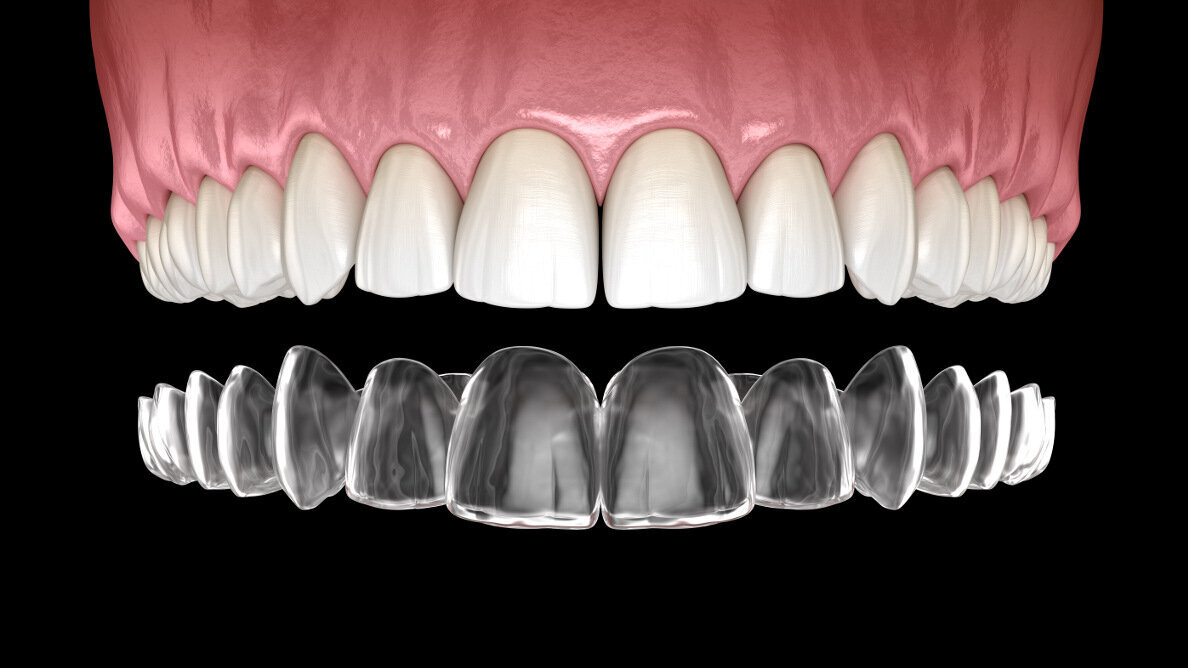 Pent-up demand helps Align Technology top pre-COVID-19 sales