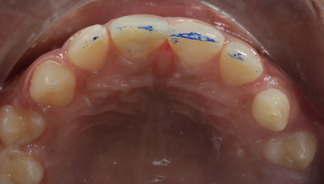 Fig 6: Occlusion was checked and adjusted accordingly.