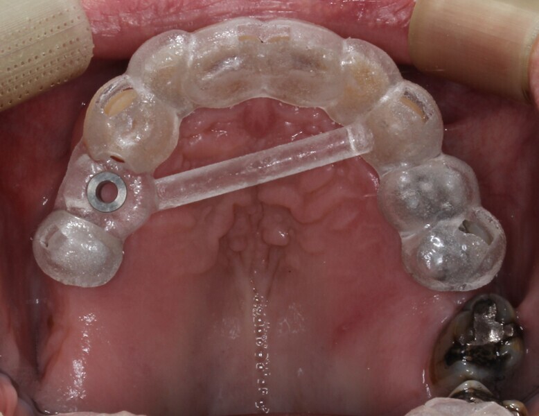 Fig. 15: Surgical guide in situ.