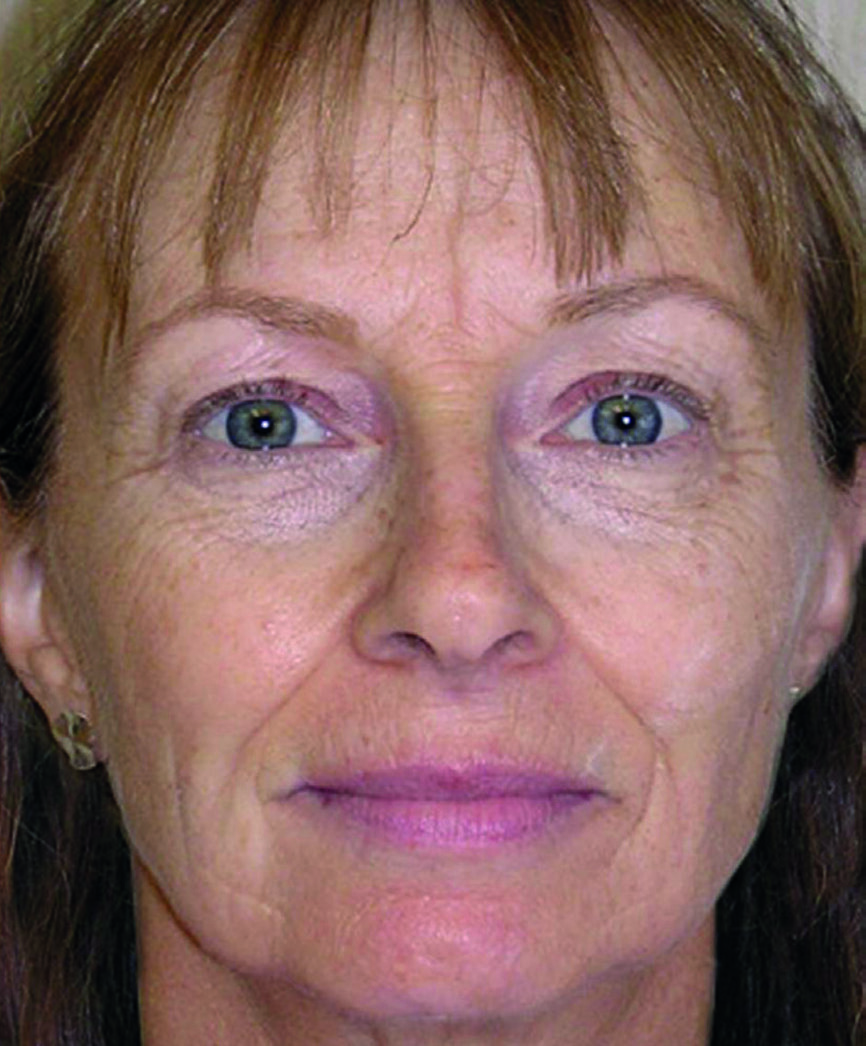 Fig. 7a : Photographies du visage avant et après.