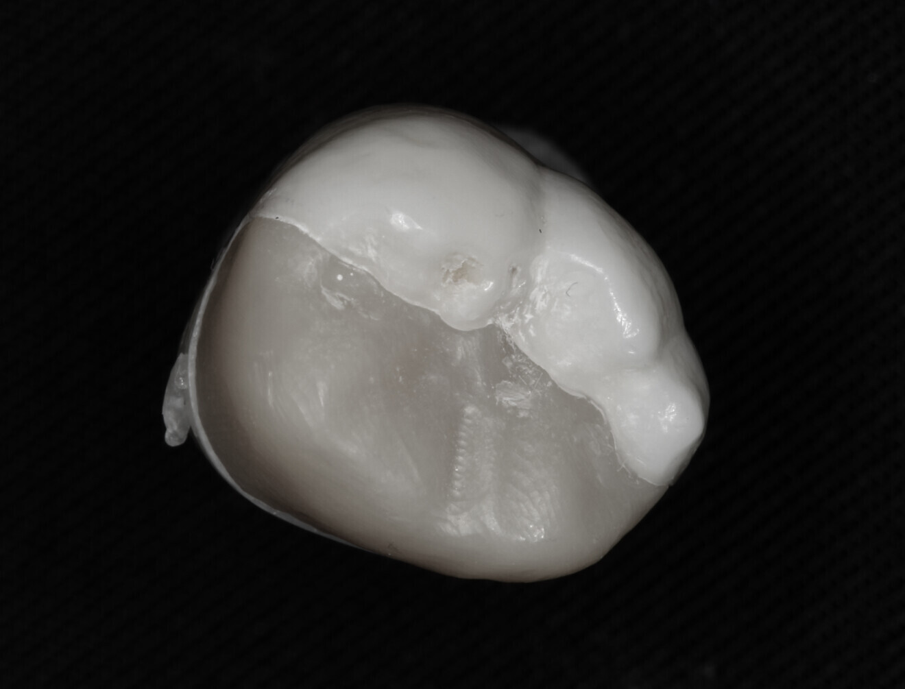 Fig. 13: Zirconia onlay.