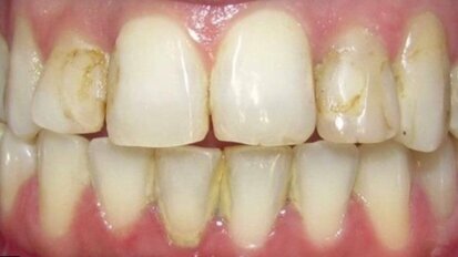 Estética y blanqueamiento dental en la era digital  (Capítulo 10)