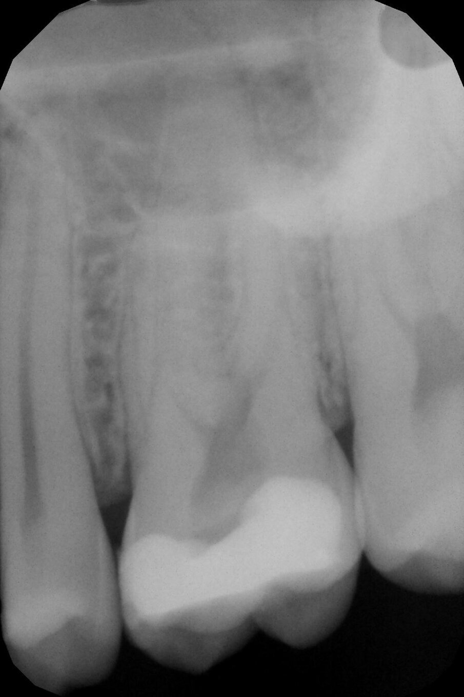 Fig. 1 - Rx periapicale preoperatoria del 2.6.