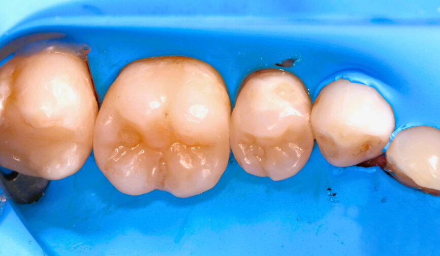 Fig. 9: Polishing is not only a matter of aesthetics; it also has an impact on oral health. 