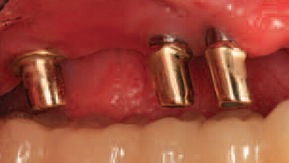 Study finds that shorter waiting time between procedures is adequate