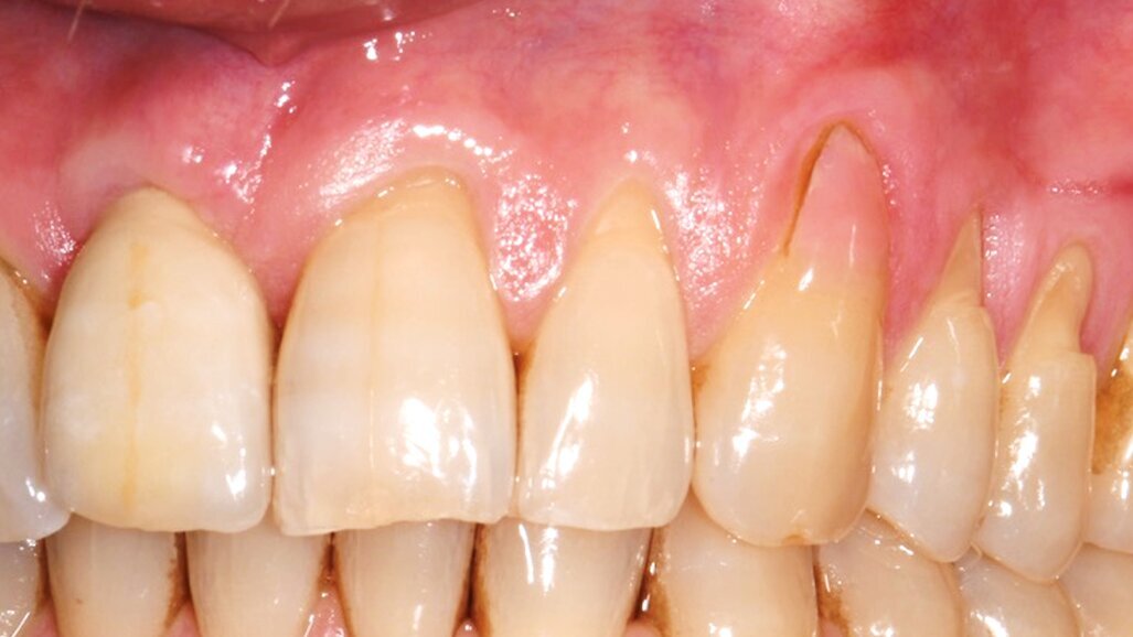 El 72% de los adultos mayores presenta recesión gingival