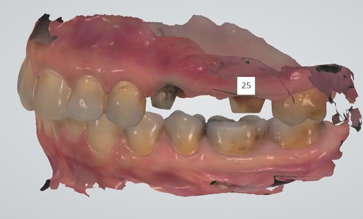 Fig. 10 - Dopo aver rilevato le varie impronte si procede alla relazione centrica o visione vestibolare. Il grande vantaggio offerto è che basta un solo punto d’appoggio per rilevare la relazione d’occlusione centrica del paziente, per contro se la chiusura è errata si trasmette un grave errore che potrebbe compromettere l’intero progetto protesico.
