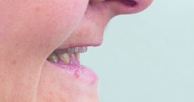 Combined CAD/CAM-assisted treatment, for a new, beautiful smile