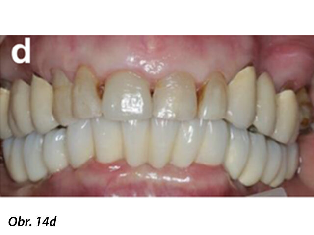 Zdravý stav periimplantátové sliznice a finální CAD/CAM náhrada bezprostředně po nasazení pacientce.
