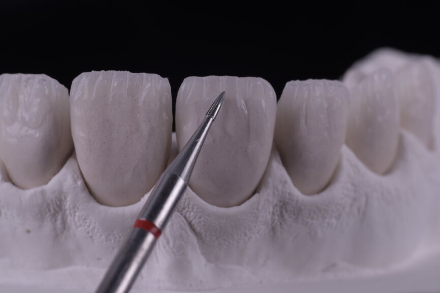 Fig. 70: Tungsten bur being used for waving grooves.