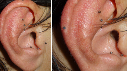 Auricoloterapia ed odontoiatria: nuove sinergie per l’odontoiatria olistica