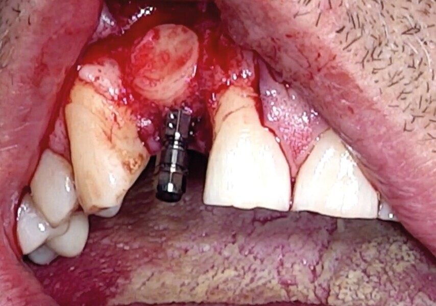 Fig. 18 : Pastille corticale impactée sur l‘os particulaire et créant un coffrage.
