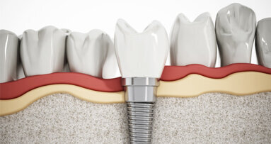 Immunreaktion bei Implantaten vermeiden