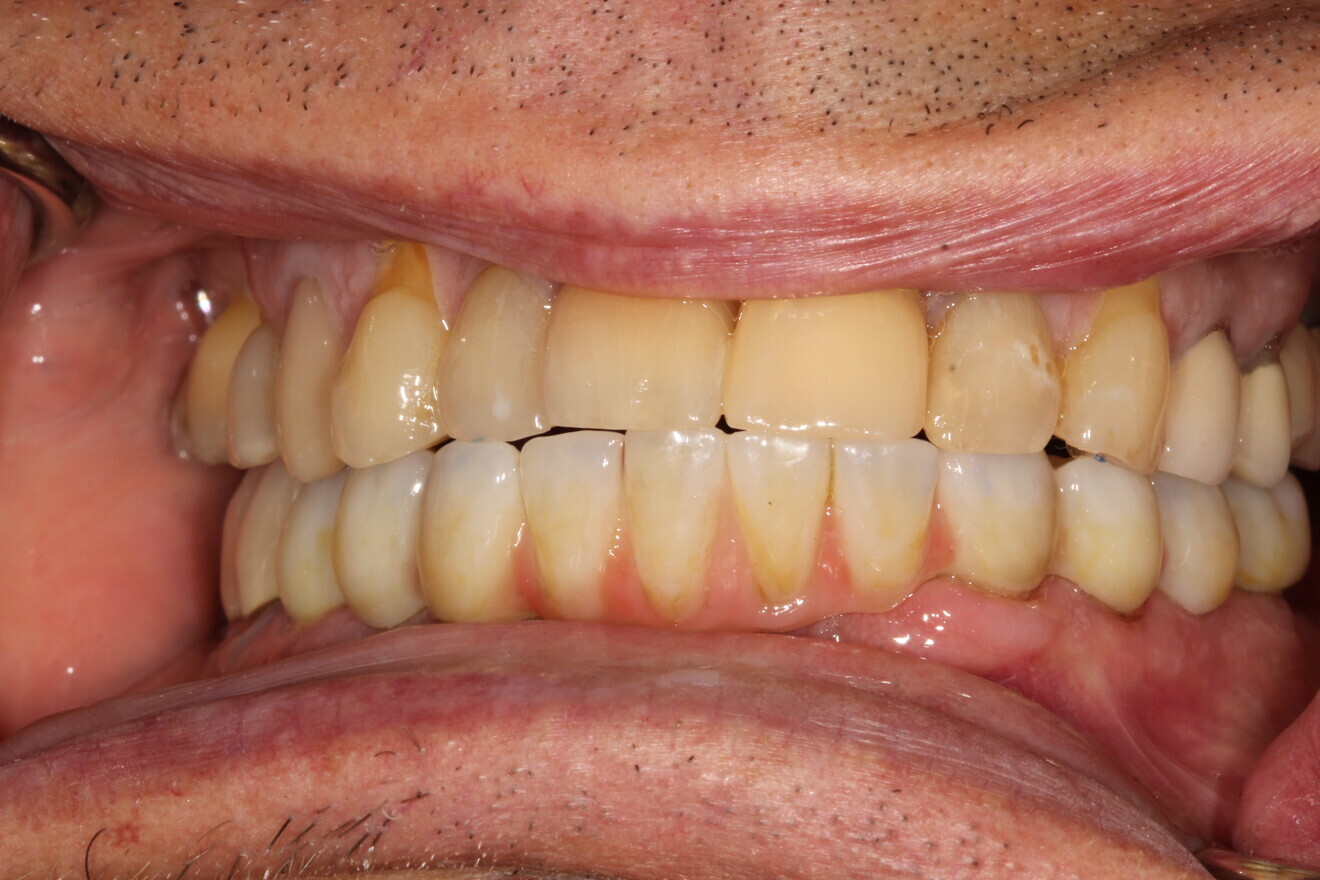 Fig. 13: New temporary restoration in situ.