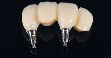 Okamžitá implantace a CAD/CAM rekonstrukce v estetické zóně