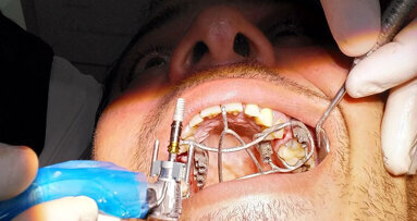 Middle East’s First Metal 3D Printed Surgical Guide