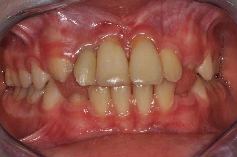 Ryc. 1_Stan miejscowy przed ekstrakcja zębów 11 i 21.