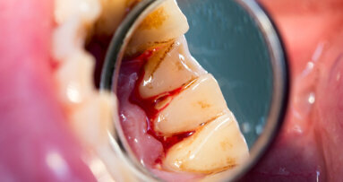 Periodontitis linked to higher mortality rate of cirrhosis patients