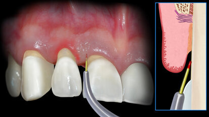 Il laser a Diodo: tecniche operative step by step, applicazioni, protocolli e casi clinici con follow-up