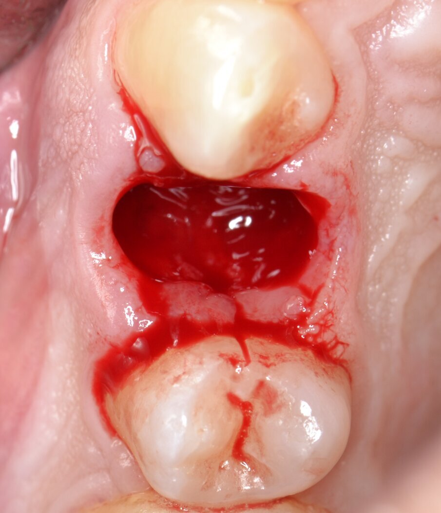 Fig. 7 - Alveolo postestrattivo integro.