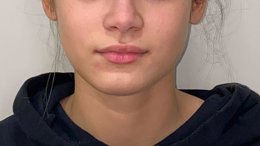 Fig. 1_Viso pre-trattamento.