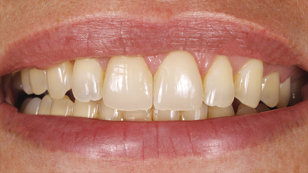 Fig. 16. Resultado: el contorno de los bordes incisales armonizó con el contorno de los labios.