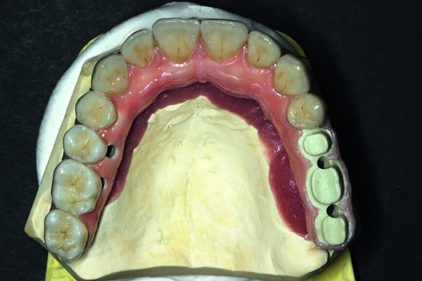 Fig. 20: Prosthetic work based on a model where veneering of the gum was started and with crowns.