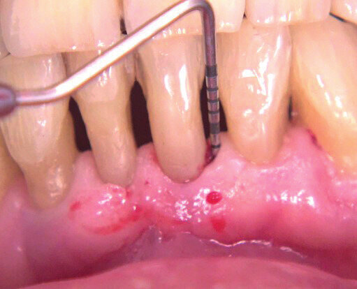 Figg. 6a, 6b - Sondaggio dopo terapia causale.