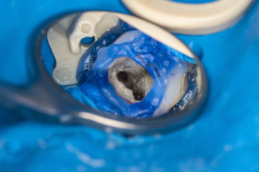 Fig. 21: Pulp chamber after the irrigation protocol.